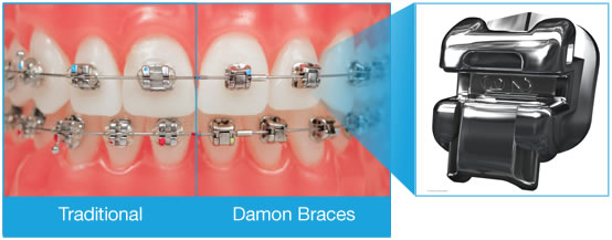 Damon Braces